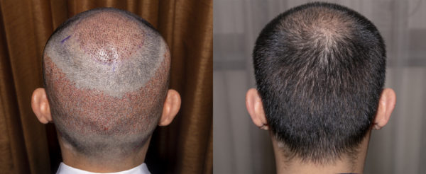 пересадка волос, до и после