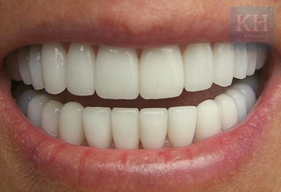 Что такое художественная реставрация зубов и в чем ее особенность